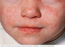 measles