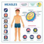 measles